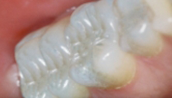 tooth colored fillings