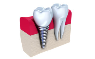 Justin Tebbenkamp DDS - Blacksburg Dentist -Dental Implant