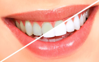 Justin Tebbenkamp DDS - Blacksburg Dentist -Teeth Whitening